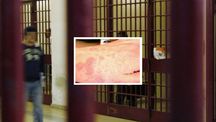 Altro che Covid, la scabbia 'invade' Poggioreale: detenuti infetti e isolati