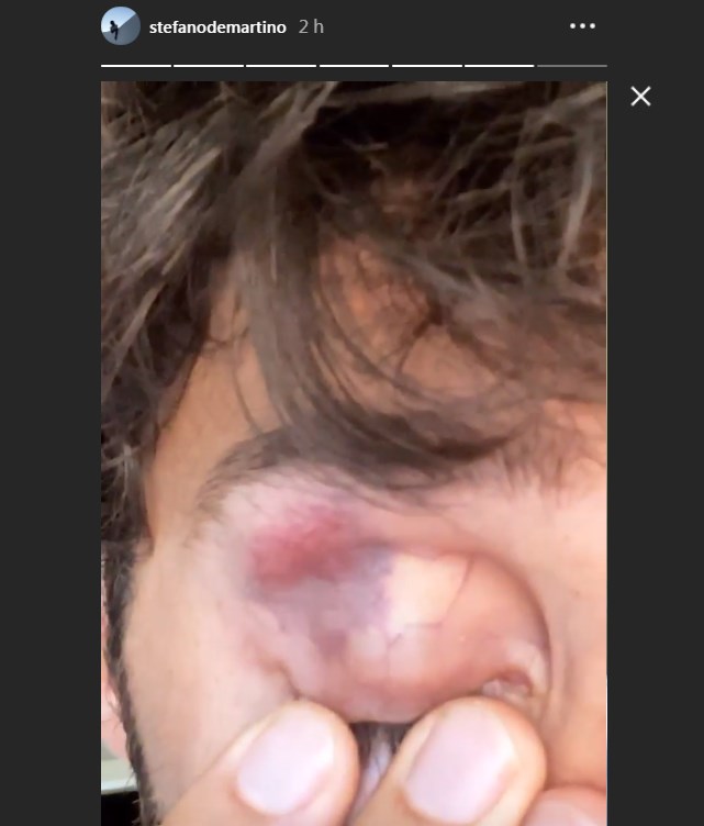 Stefano De Martino torna a Milano e spunta un occhio nero: "Non so se ve l'ho detto" 