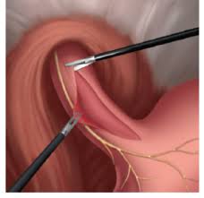 Piccola paziente albanese salva grazie a un innovativo intervento al Policlinico Federico II