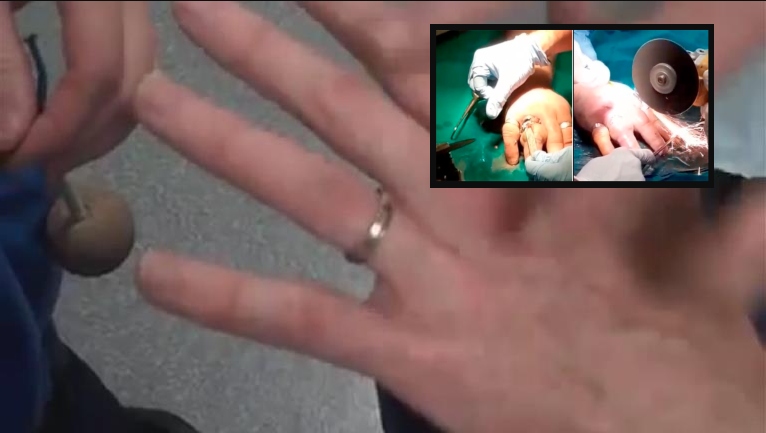 Fede 'strozzina', l'anello è troppo stretto: intervengono i pompieri con il flex